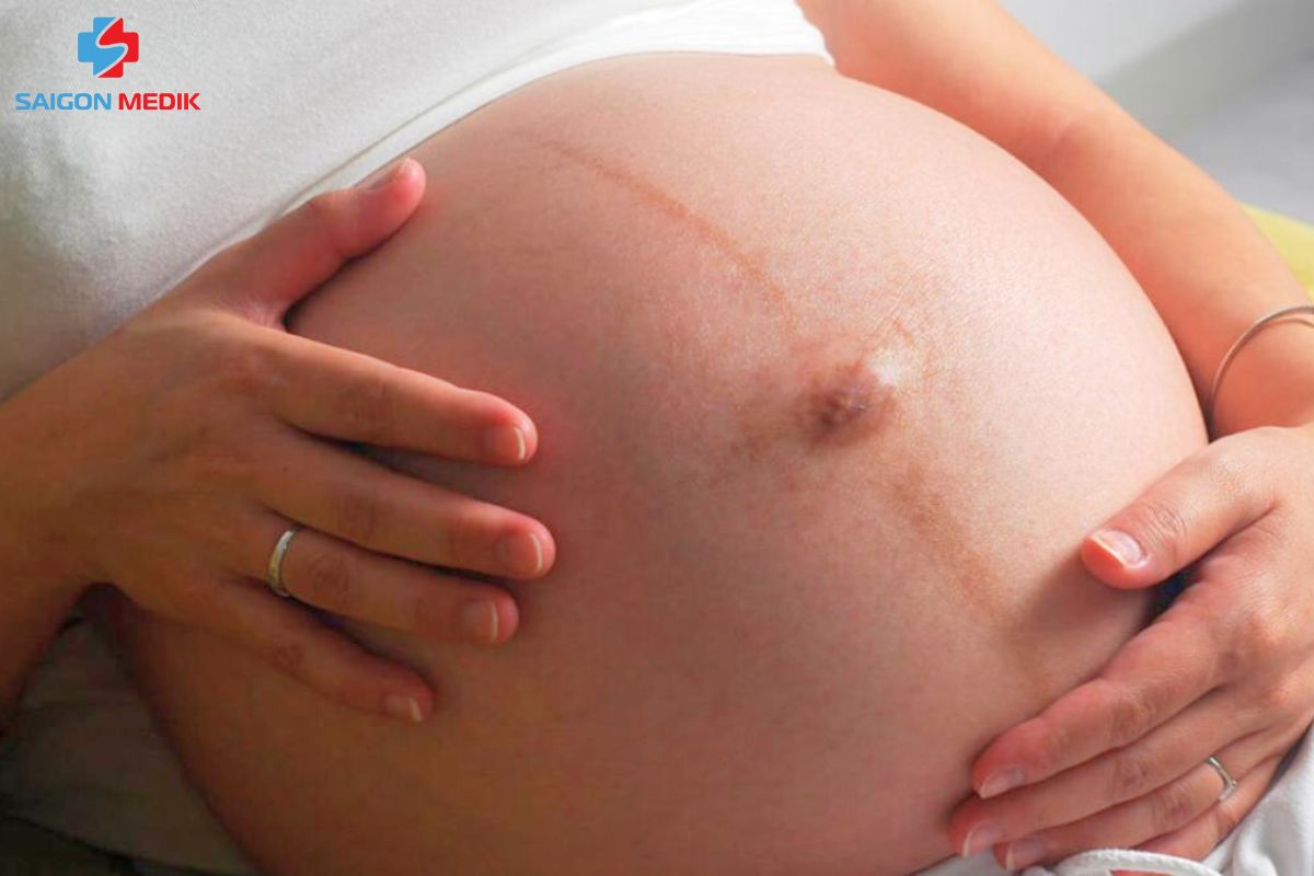 Đường linea nigra thường xuất hiện khi mẹ bầu 23 tuần 