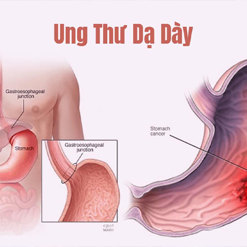 Những ai cần thực hiện tầm soát ung thư dạ dày?